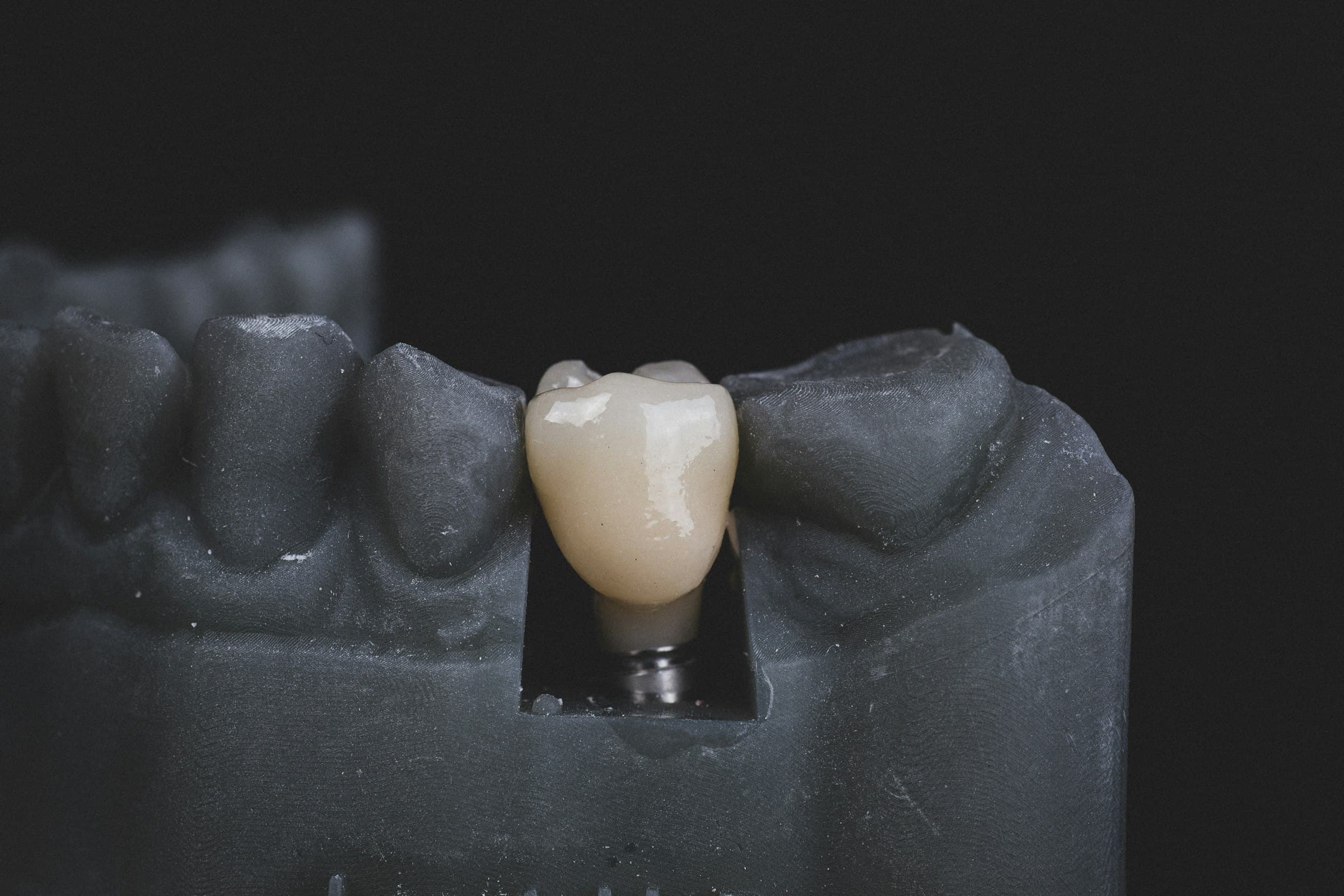 Modelo de un implante dental colocado en la mandíbula